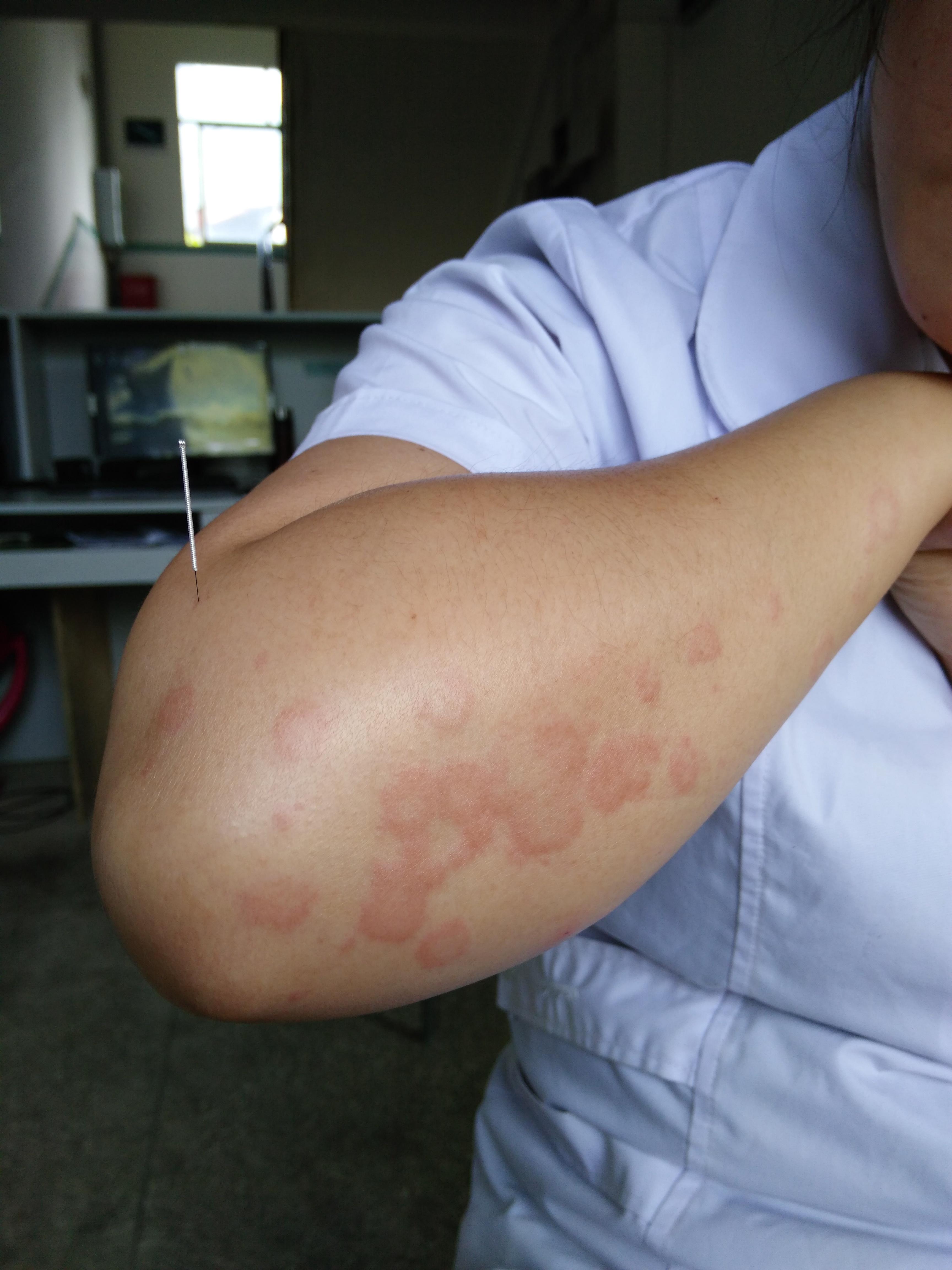 针灸处理急性荨麻疹