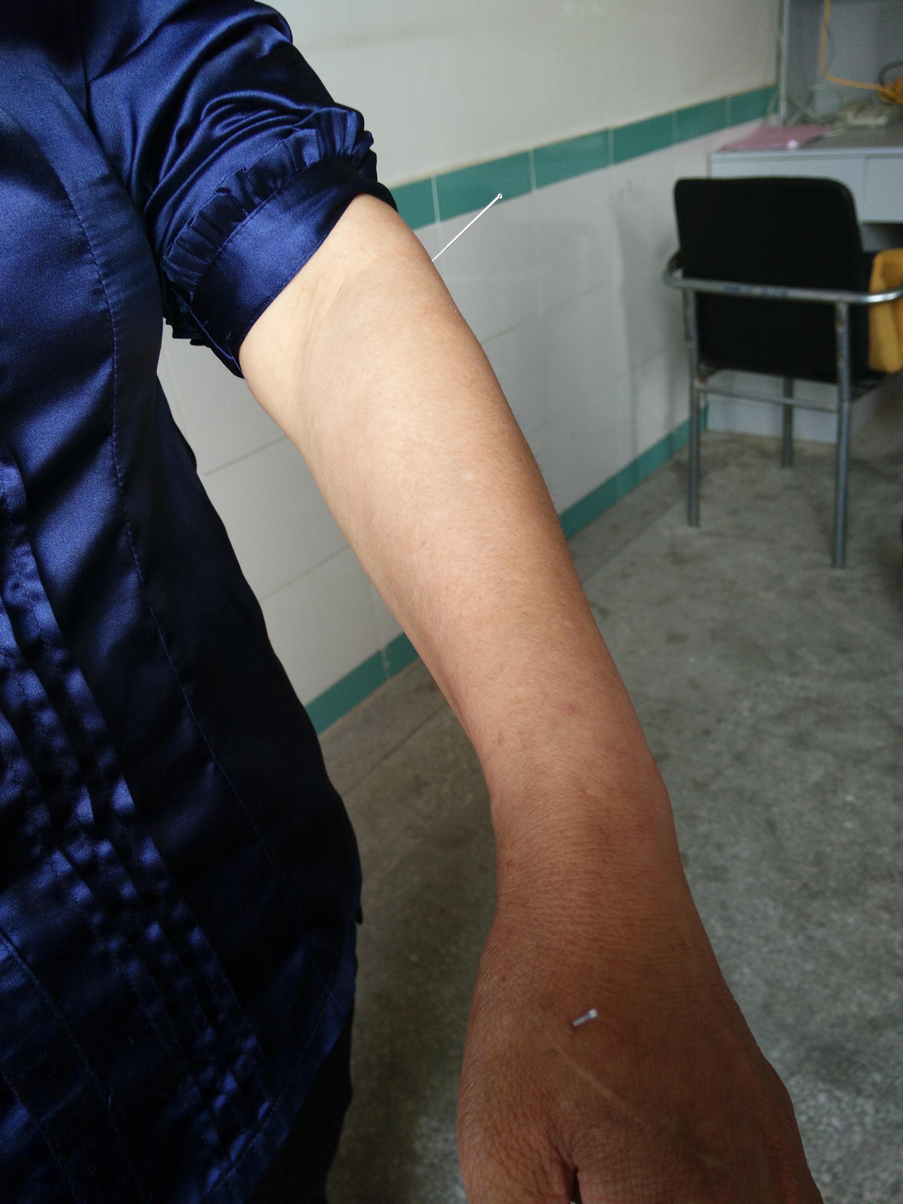 针灸处理咽喉肿痛