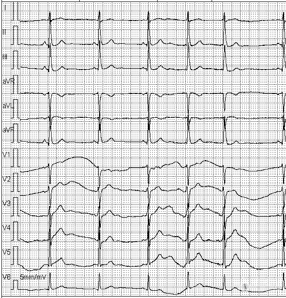 请问老师这幅图的p波时隐时现,是什么情况 - 心电图脑电图专业讨论版