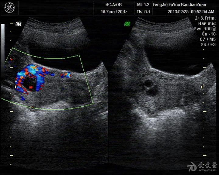 葡萄胎超声图片大全图片