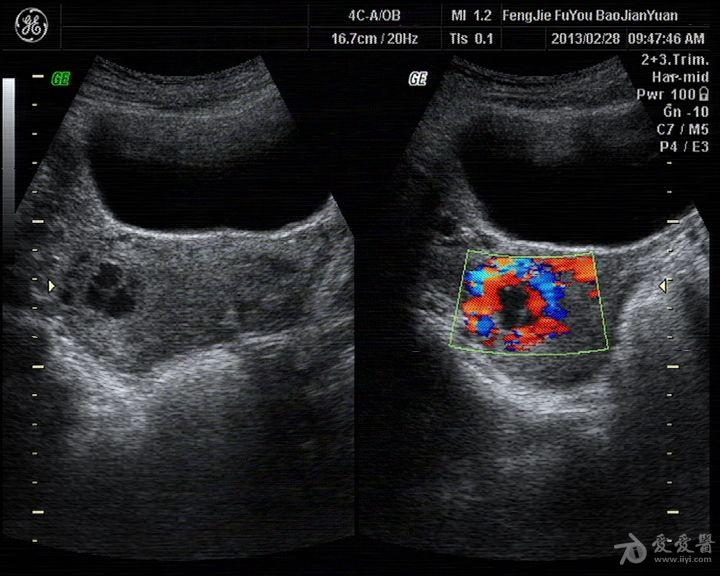 葡萄胎超声图片大全图片