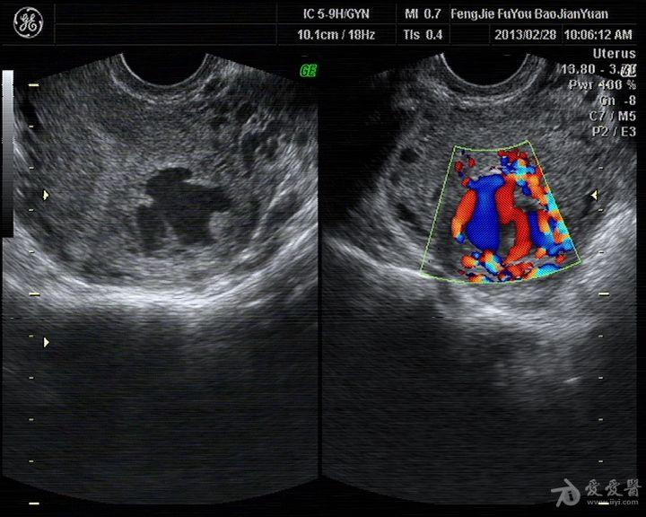 [妇科] 葡萄胎清宫术后复查