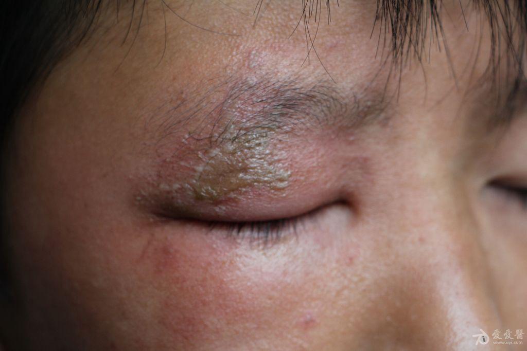 2015年皮肤版有奖病例猜答20答案隐翅虫皮炎