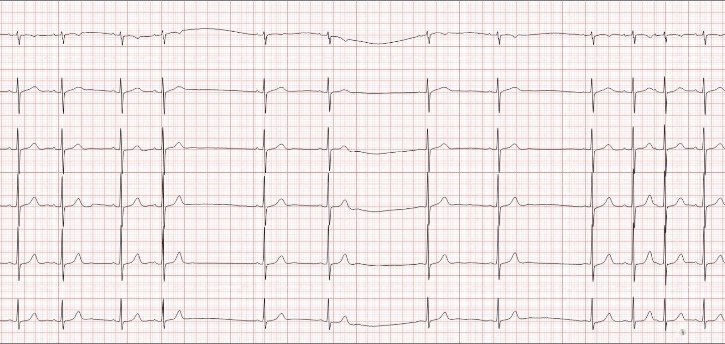 冬秋心电图讨论20150530长rr间期