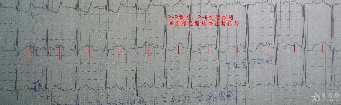 房室结双径路图片