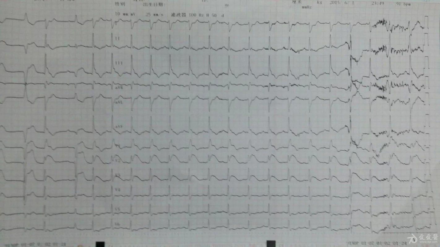 房室分离心电图图片