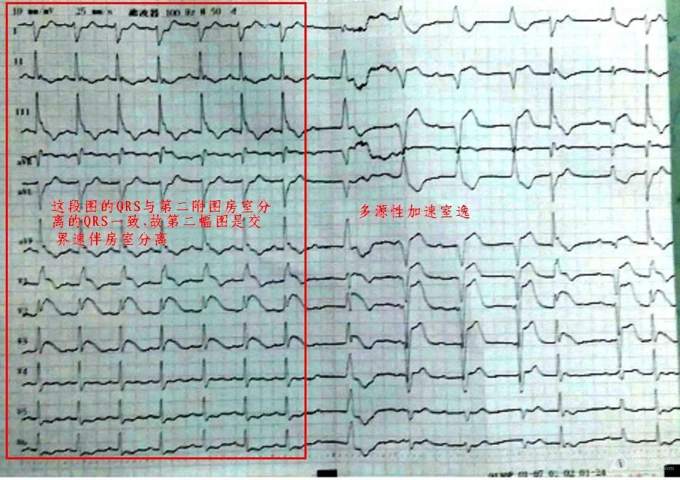 房室分离心电图图片