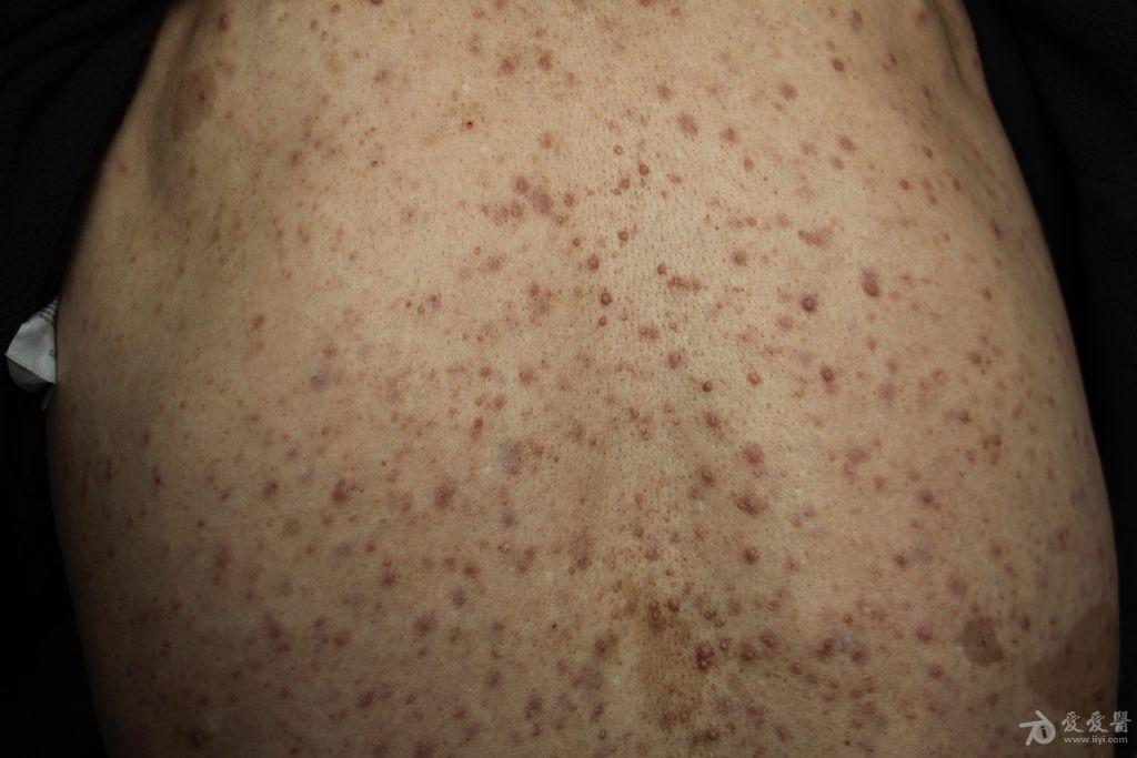 2015年皮肤版有奖病例猜答(22)答案:神经纤维瘤病. - 皮肤及性传播疾