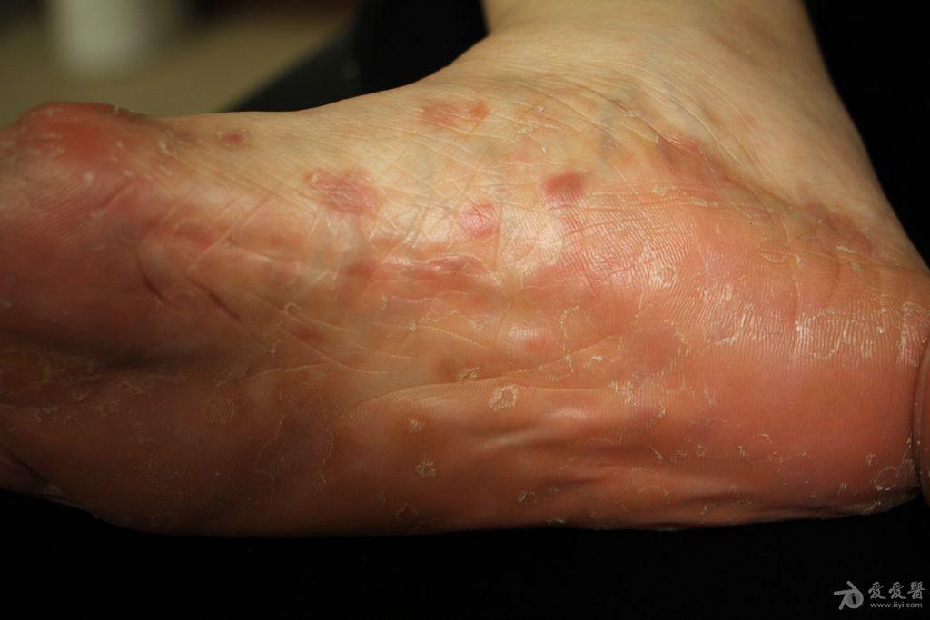 2015年皮肤版有奖病例猜答25答案二期梅毒