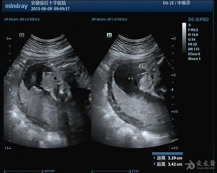 畸胎瘤影像图片