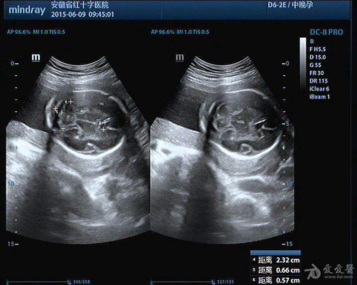 胎儿骶尾部畸胎瘤 