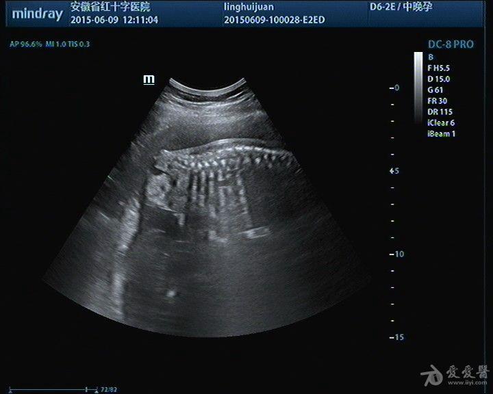 胎儿骶尾部畸胎瘤