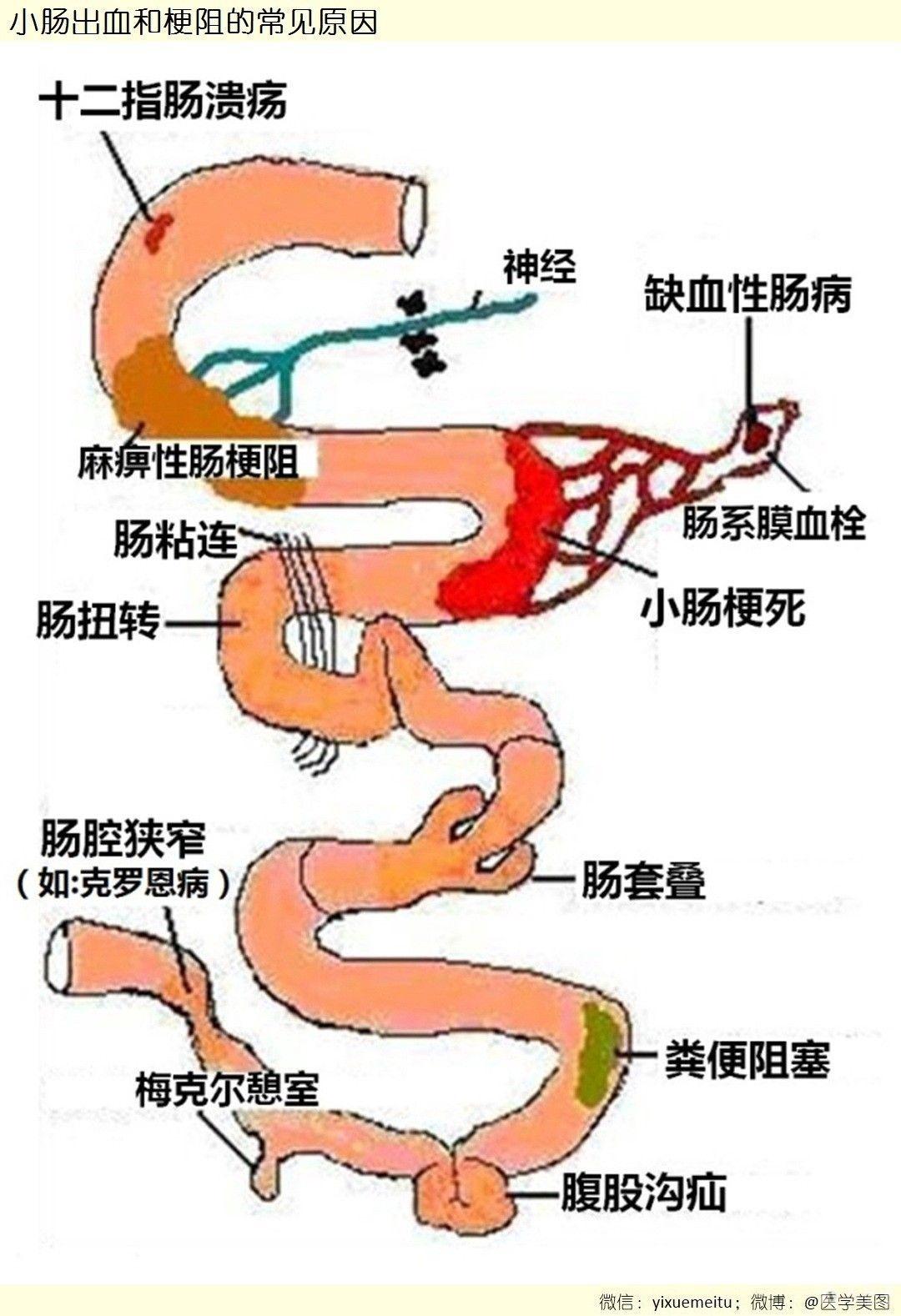 医学基础小肠出血和梗阻的常见原因