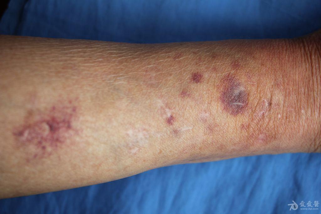 2015年皮肤版有奖病例猜答27答案中毒性紫癜药物紫癜