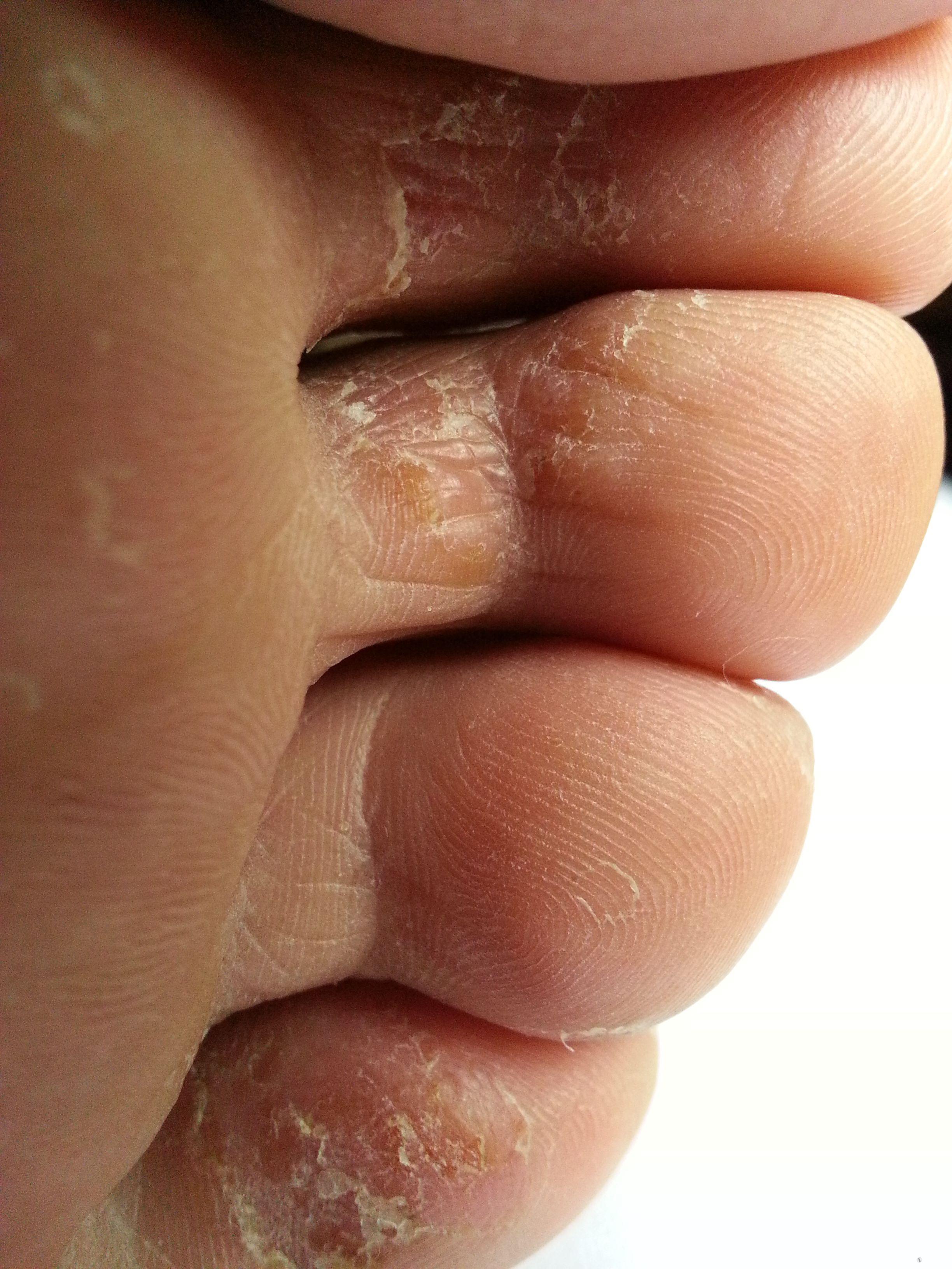 脚趾头细菌感染图片图片