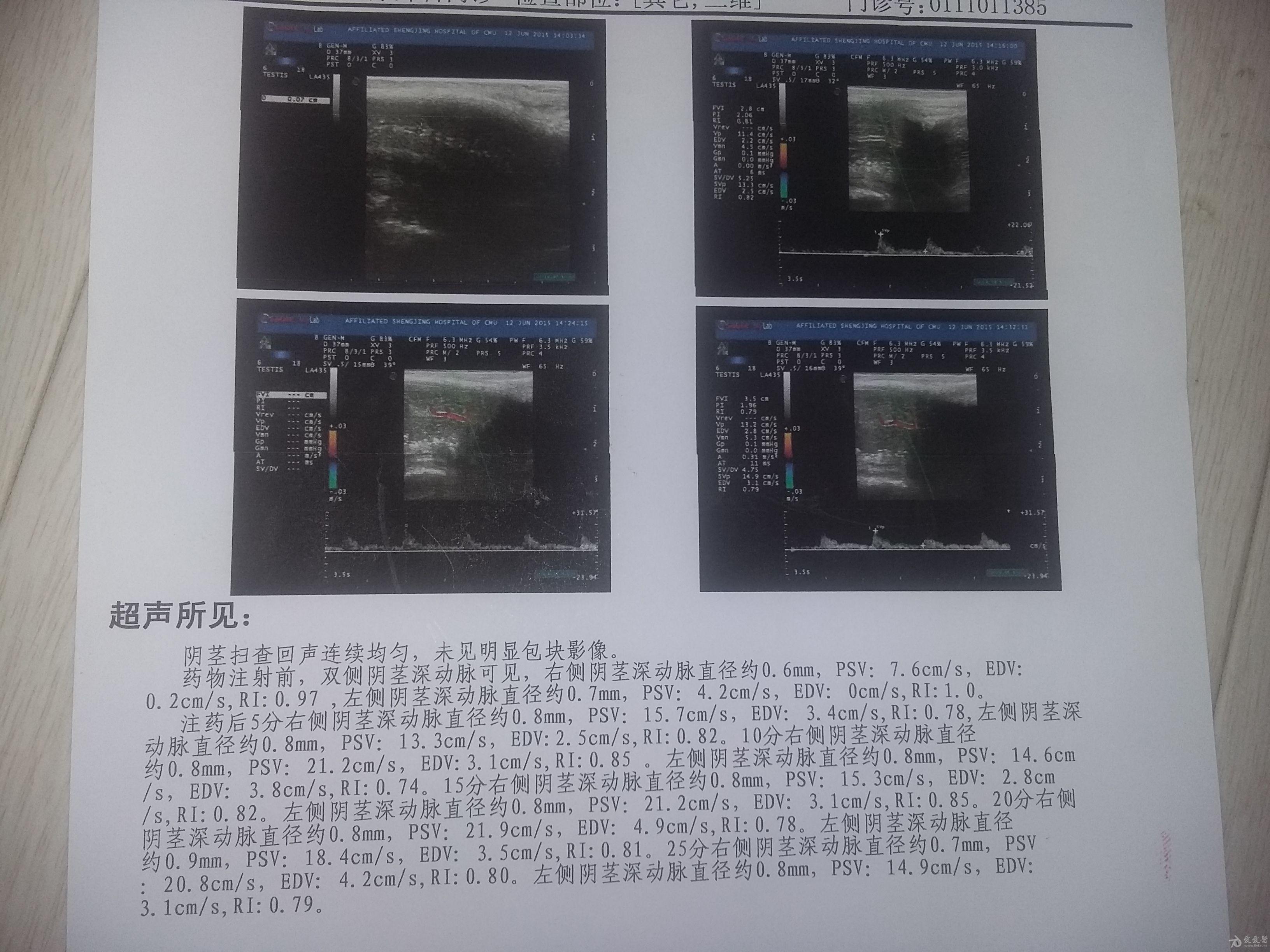 阴痉静脉纤维化图片