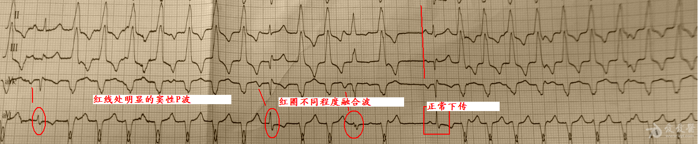 室性融合波图片图片