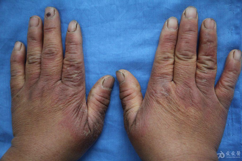 诊断:?患者因腹泻,自服"泻立停"后,既往对磺胺类药物过敏.