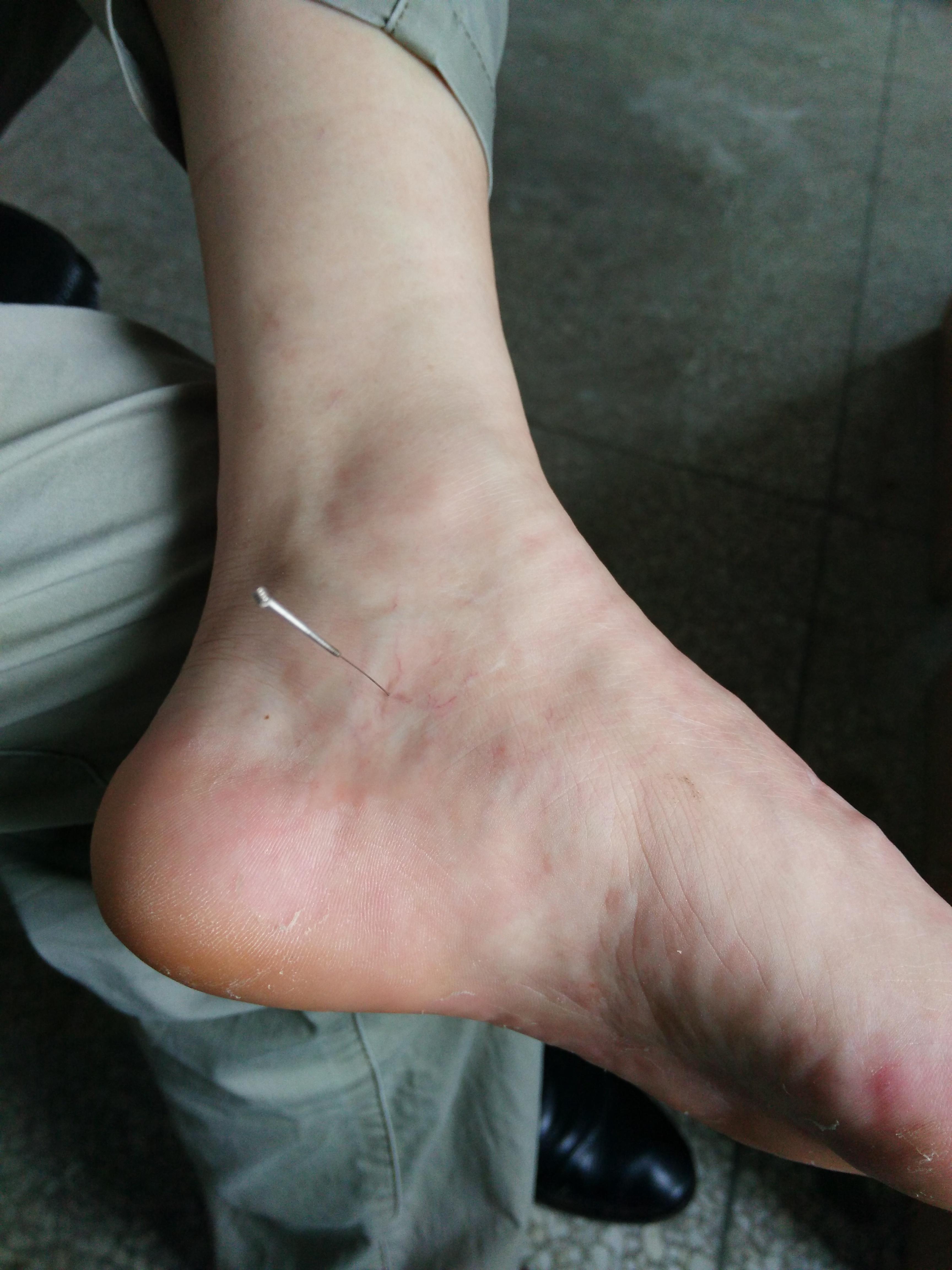 针灸脚位置图图片
