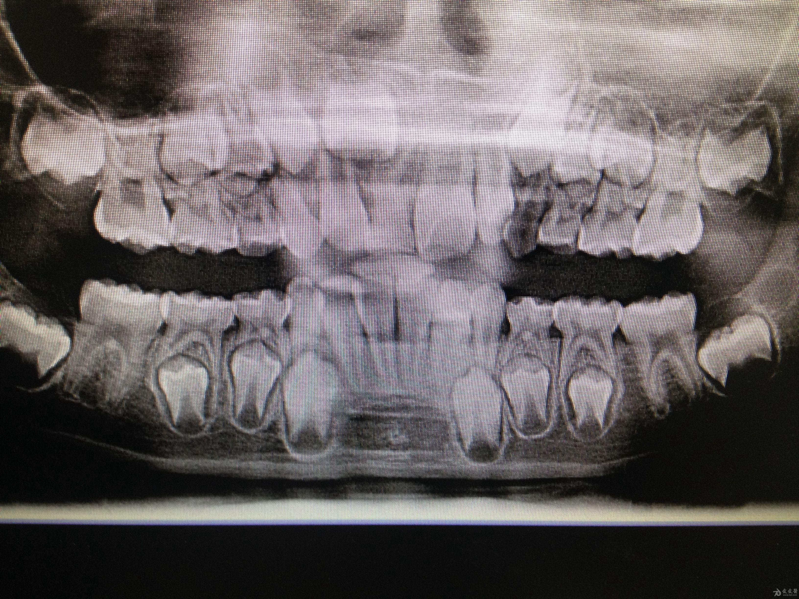 乳牙和恒牙x光图图片
