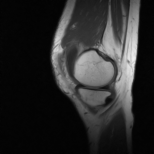 胫骨后上缘撕脱性骨折,后交叉韧带断裂?mri