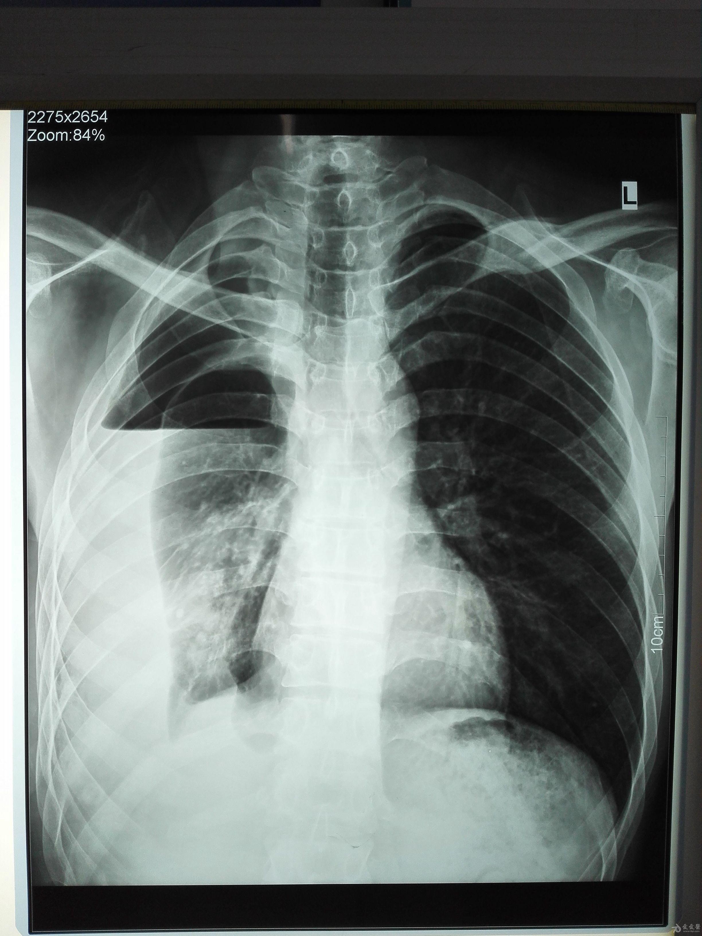 肺不张x线图片