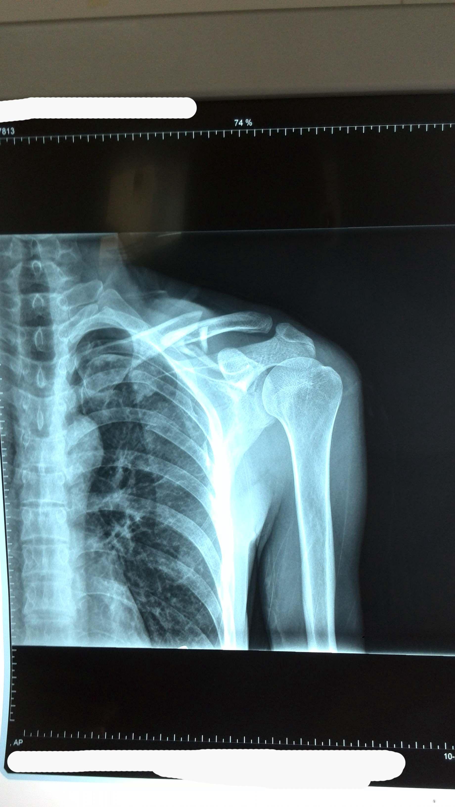 锁骨骨折术后发现肩锁关节脱位已经更新术后了