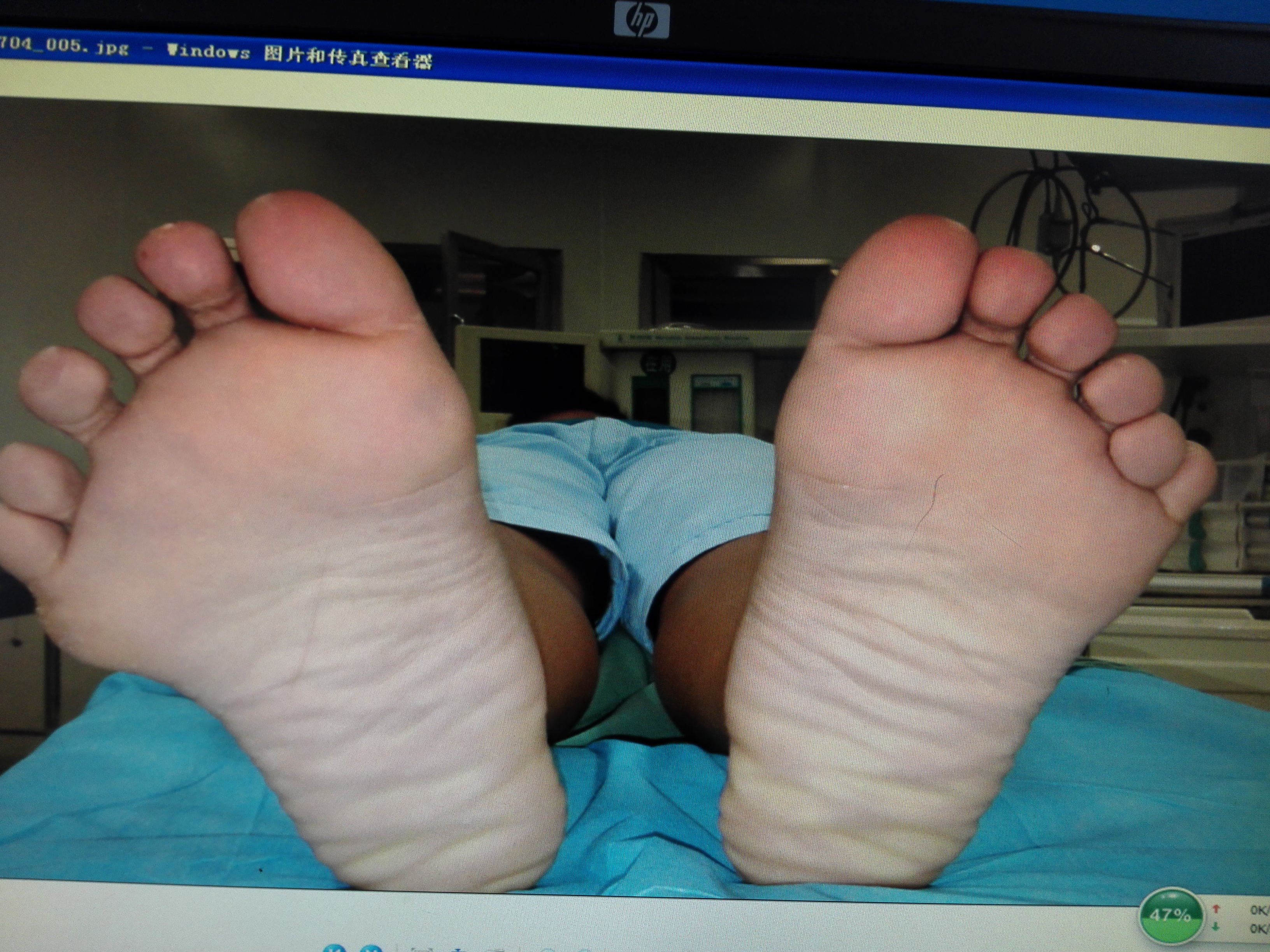 先天性双足六趾畸形一例