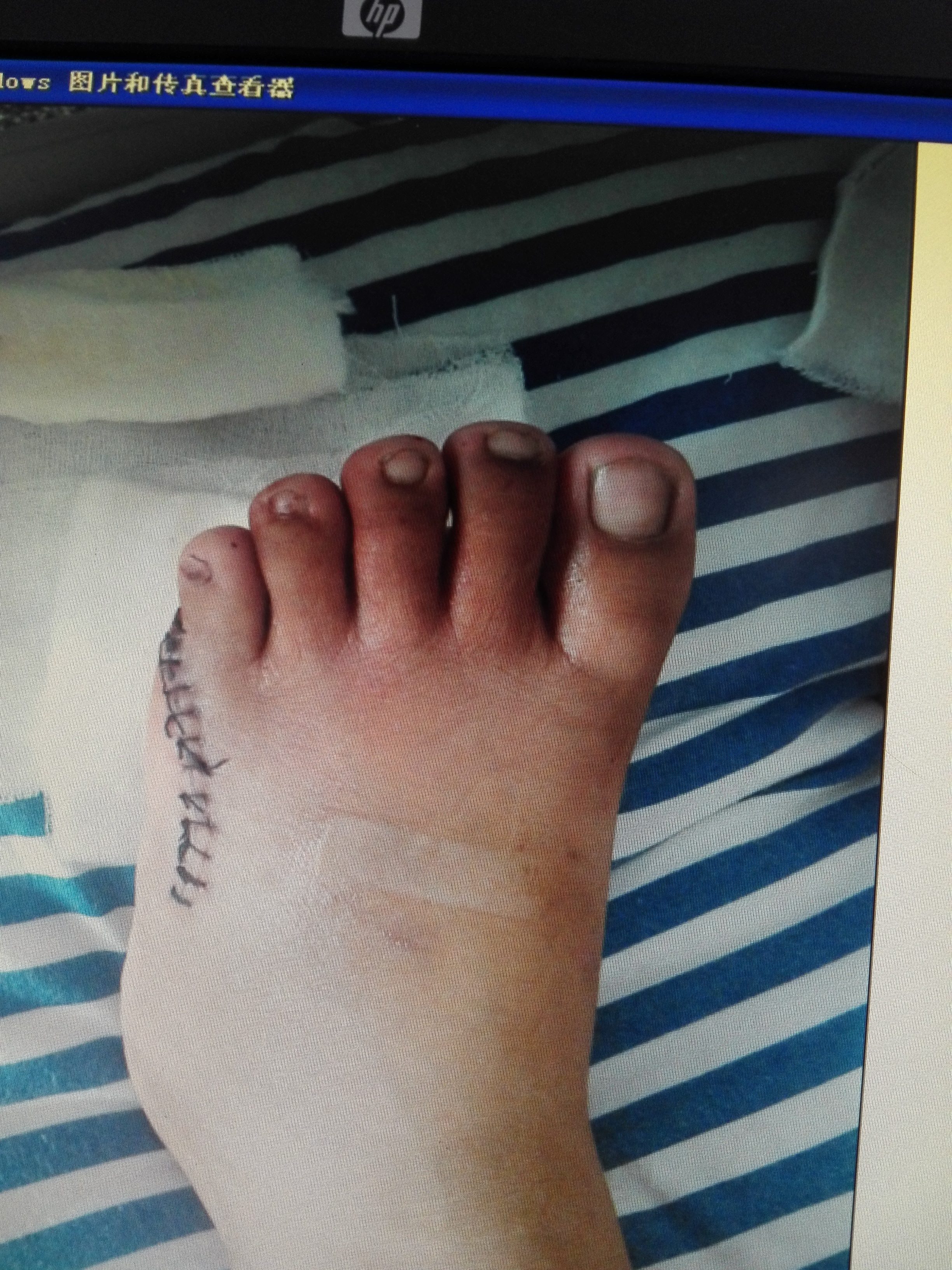 先天性双足六趾畸形一例