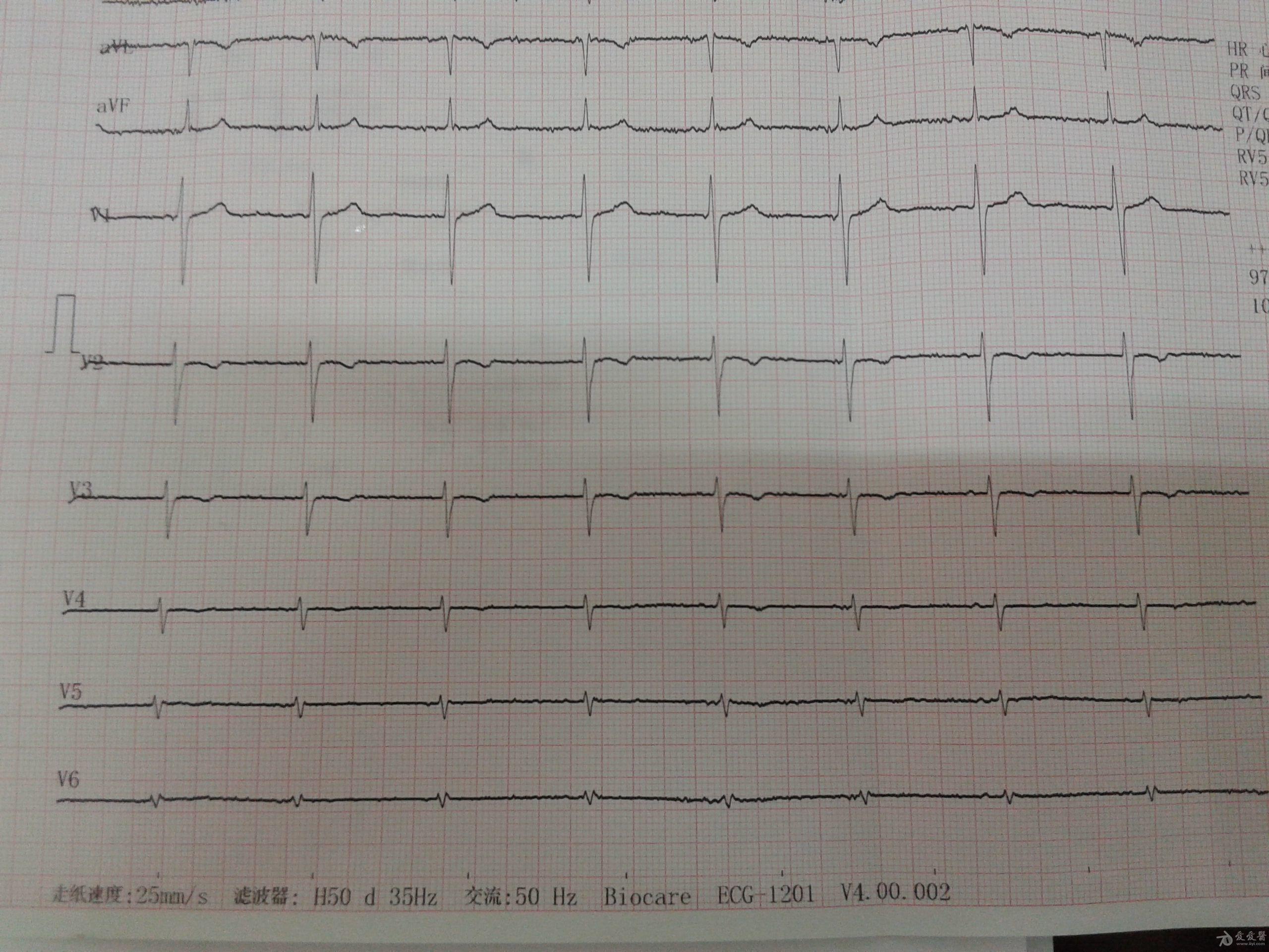 电轴右偏的心电图图片