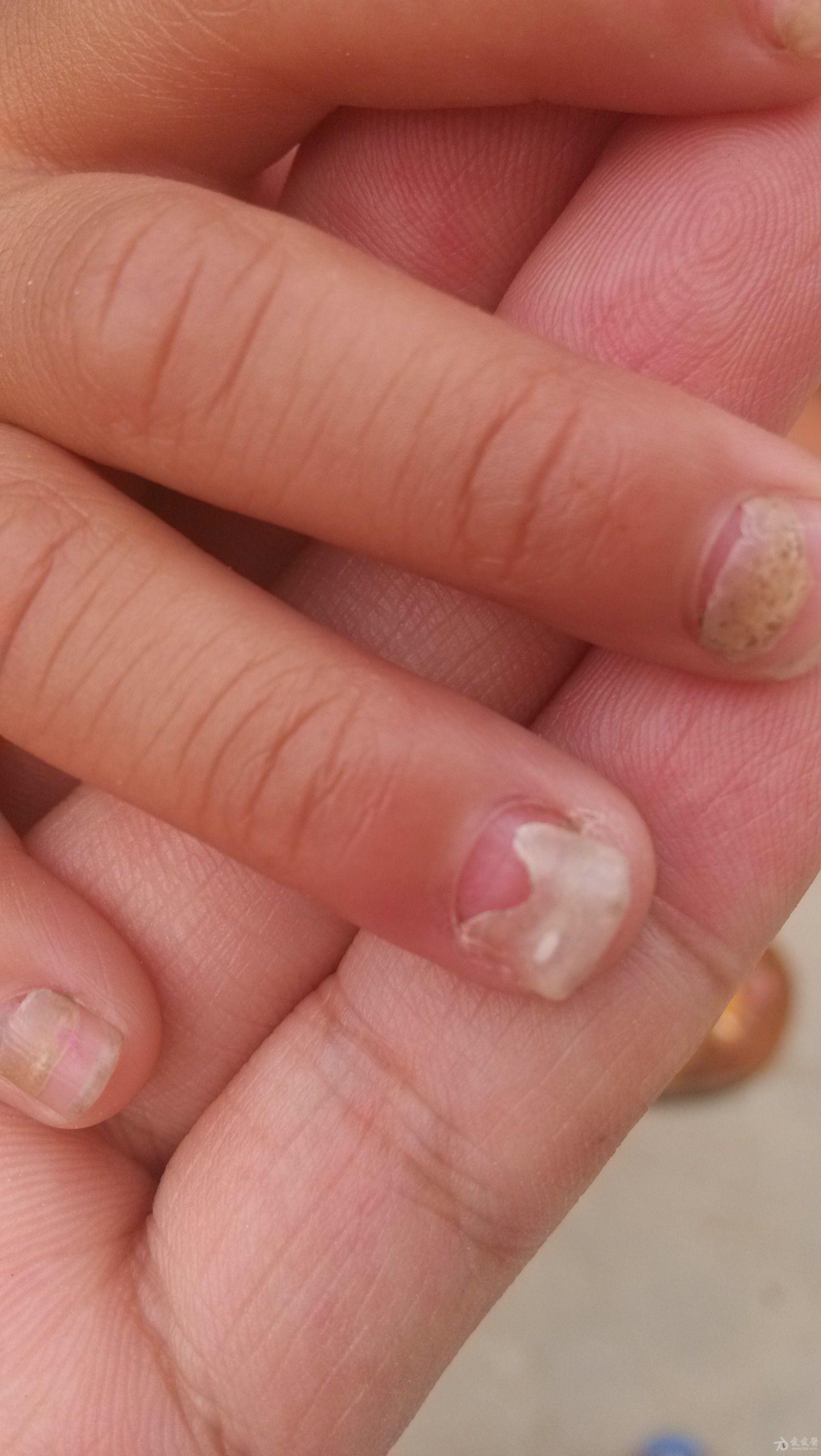 请各位老师们给帮忙看看这些孩子的手指甲是怎么回事