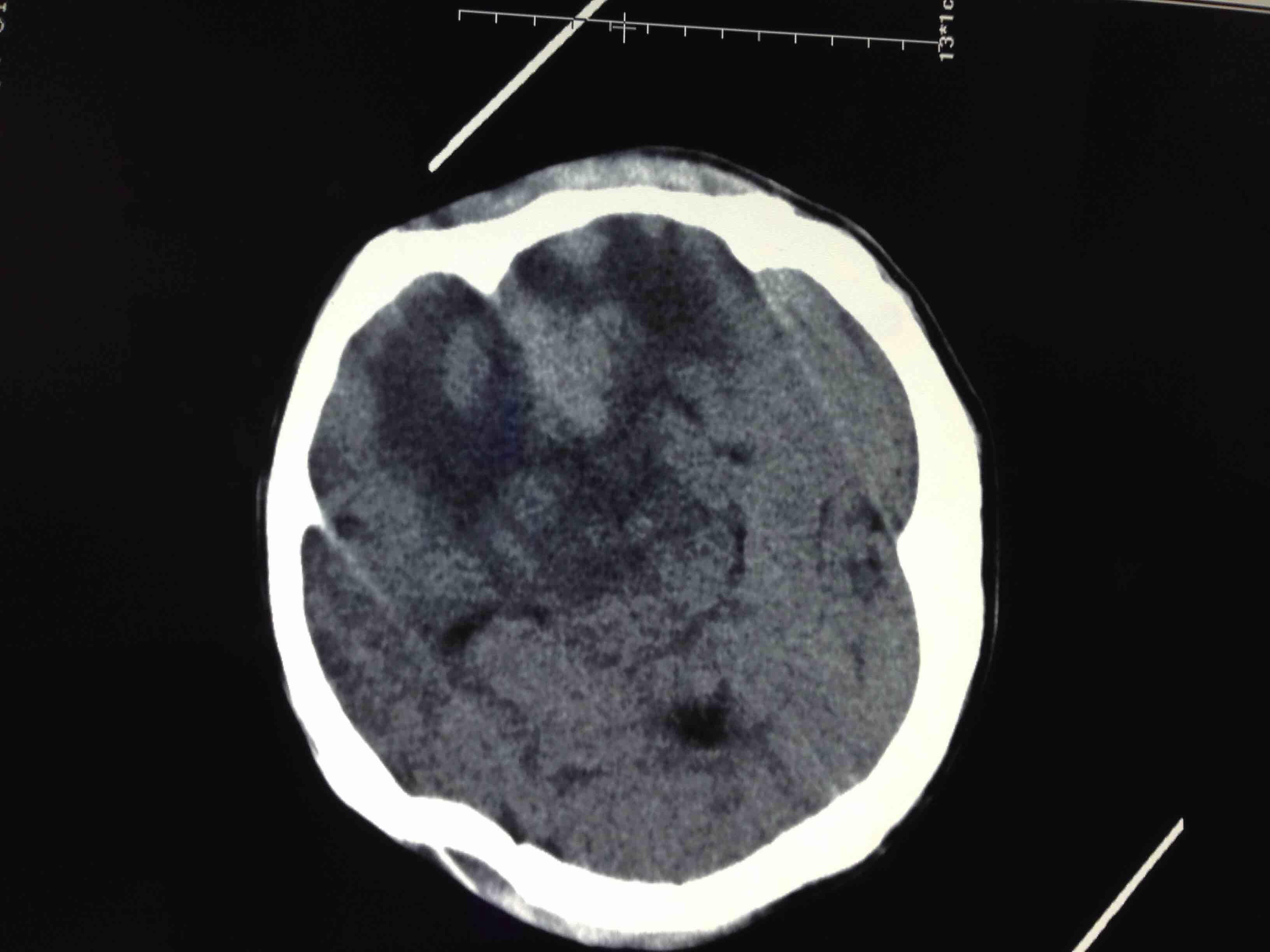 脑梗ct片子图片