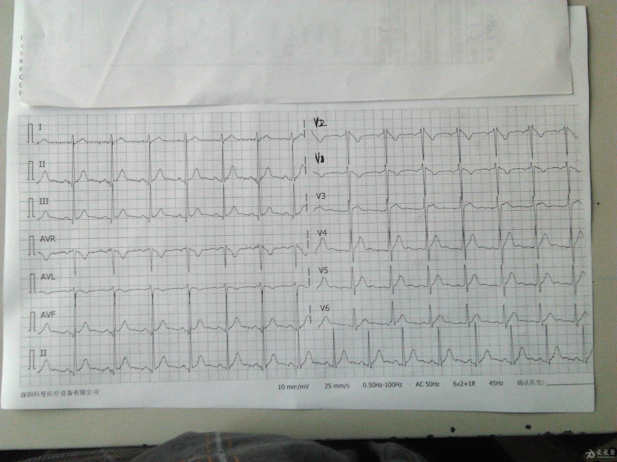 brugada样波是体检的心电图没症状