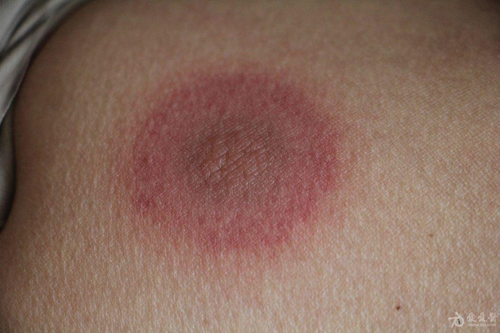 遇到这种皮损你该诊断什么诊断固定药疹