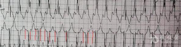 预激综合征合并室上速图片