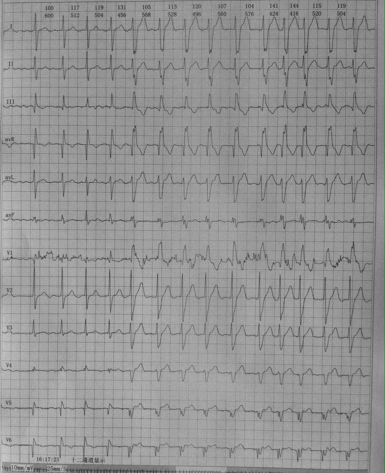 房颤伴室内差异性传导