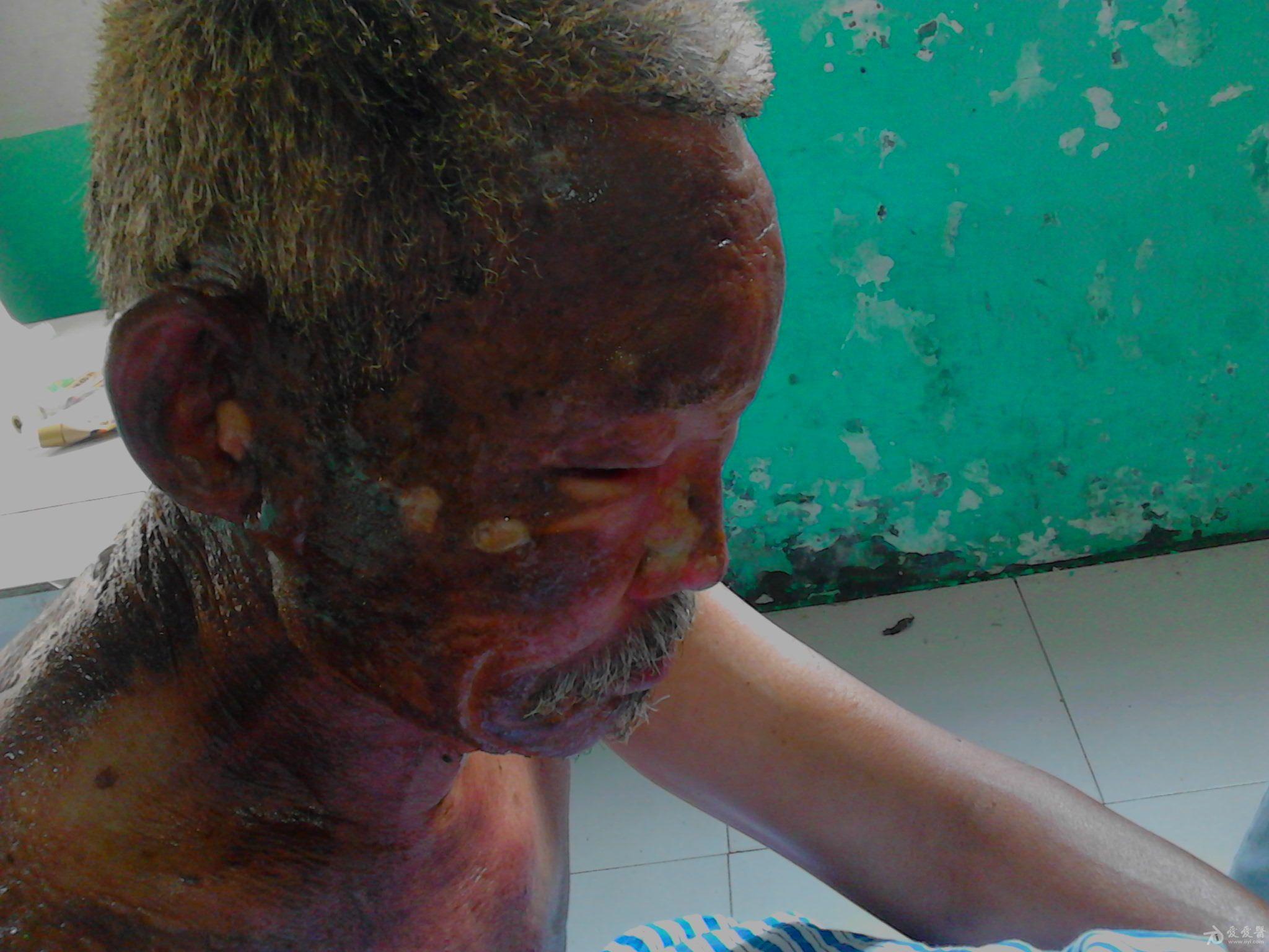 帮忙看看这个热油烫伤的病人!急!