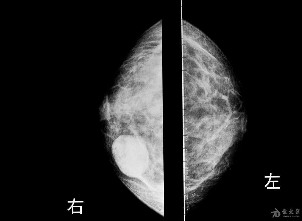 乳腺结节钼靶图片图片