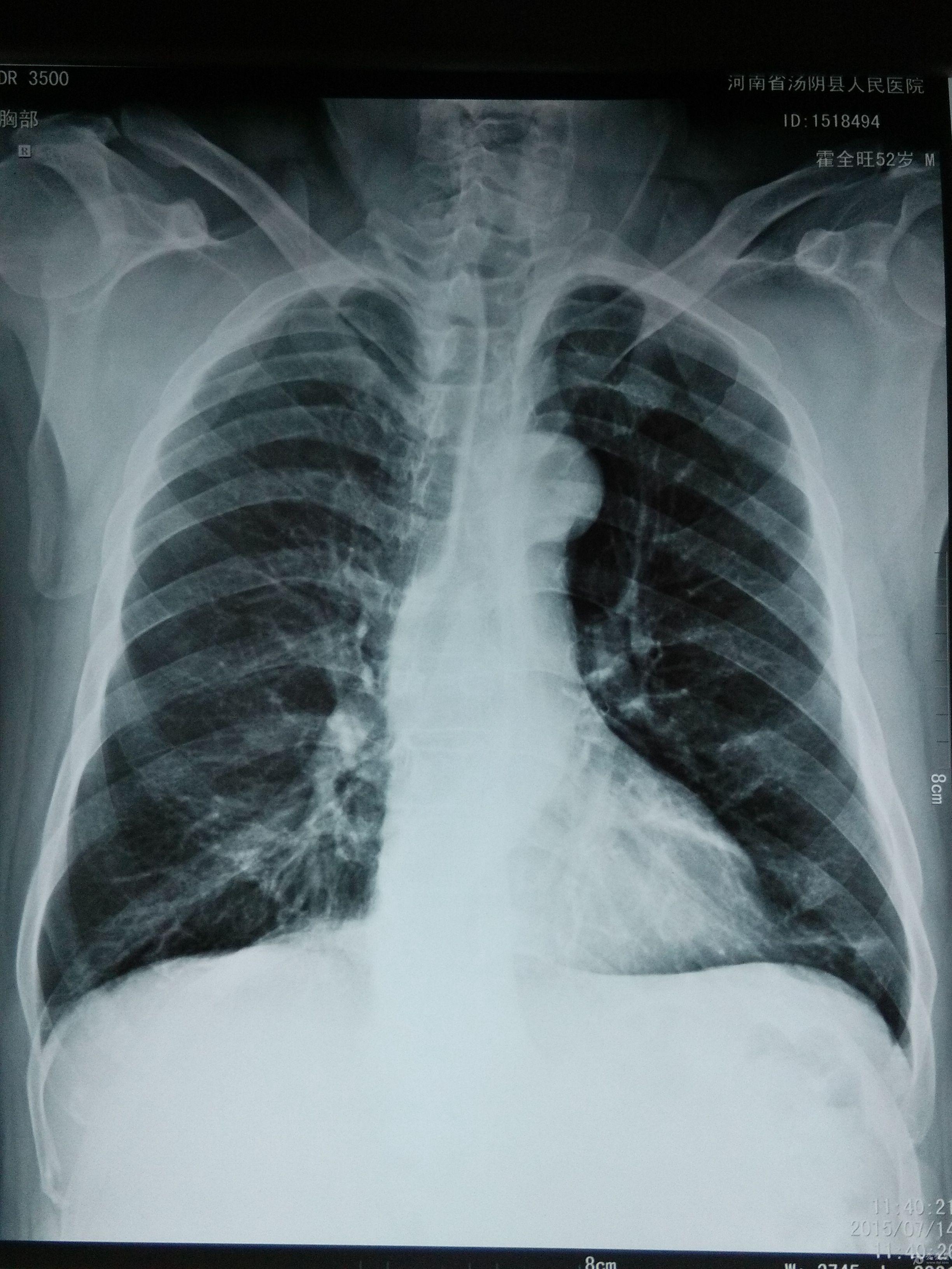 有无肋骨骨折 骨科与显微外科专业讨论版 爱爱医医学论坛