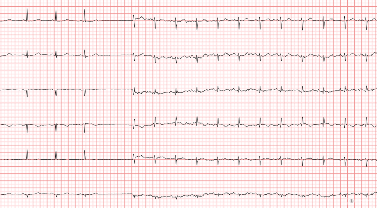 冬秋心電圖討論20150720心動過速是什麼性質