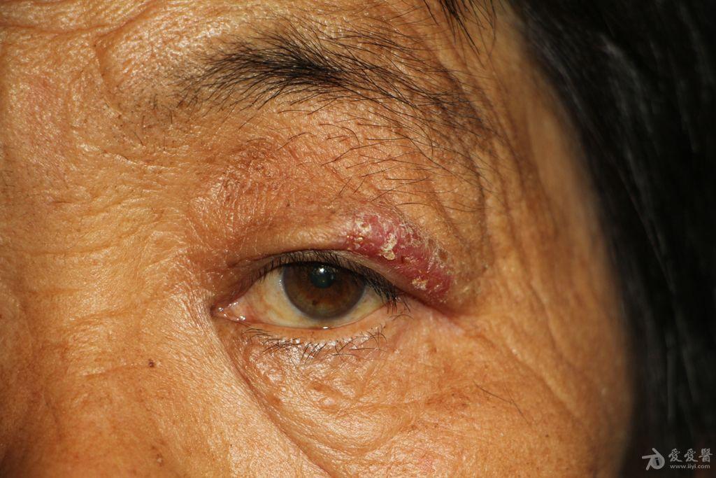 2015年皮肤版有奖病例猜答35答案孢子丝菌病