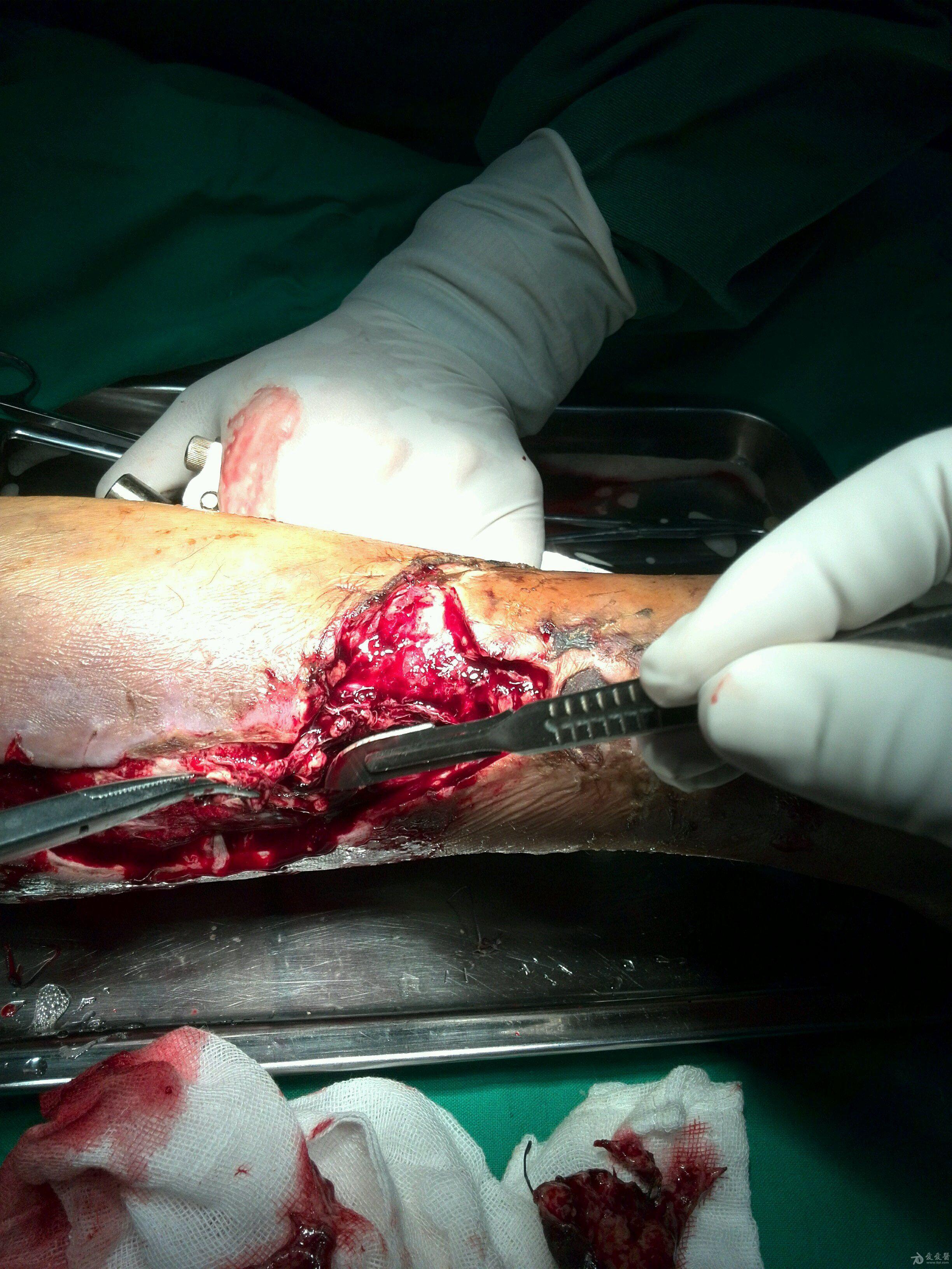 开放性胫腓骨粉碎性骨折结局已经更新