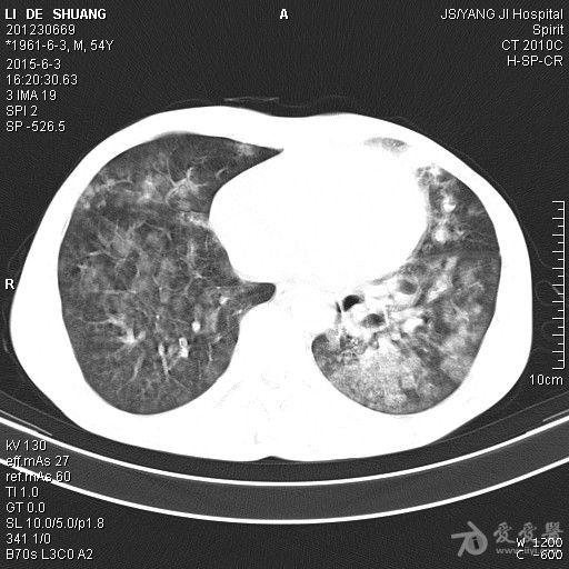 大家考虑什么我下尘肺建议到三级医院再查