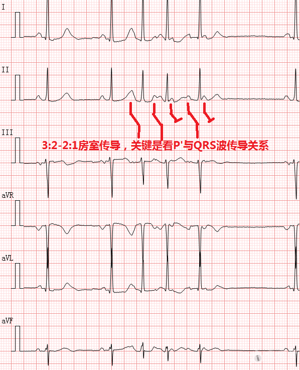 [心电图分析] 阵发性房速