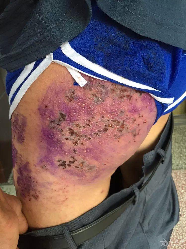 水痘合并带状疱疹一例