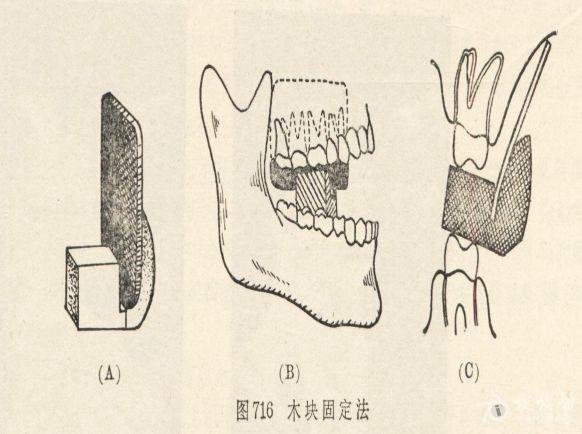 牙片摄影技术详解