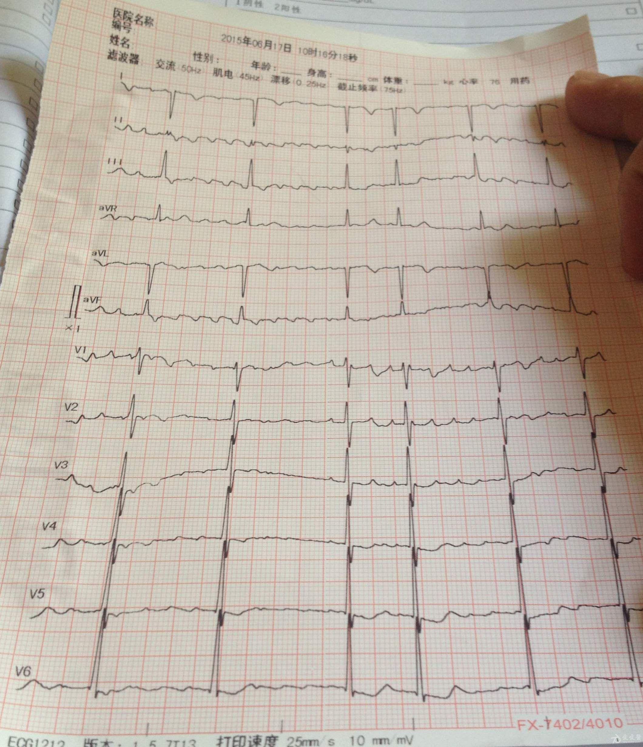 心电图红印照片图片