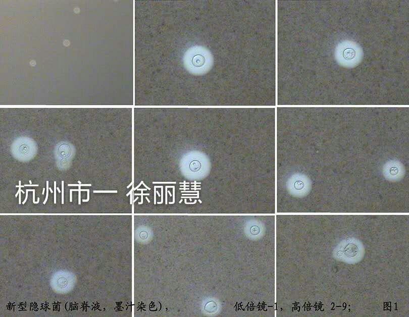 新生隐球菌墨汁染色图片