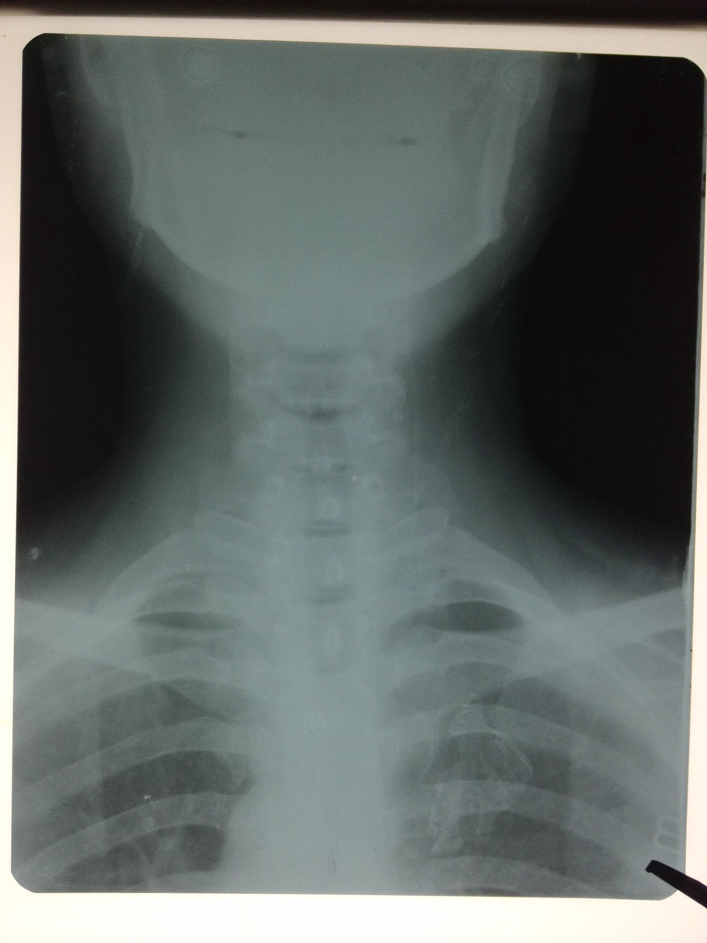 颈肋的x线图片图片