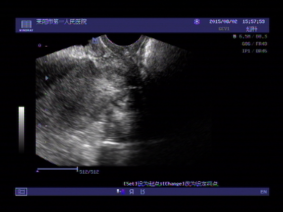 超声入门贴438宫颈癌